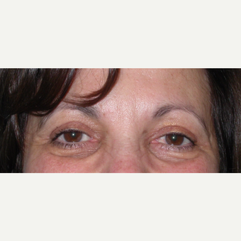 55-64 year old woman treated with Eyelid Surgery after 3070052