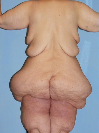 50 Year Old Female Extreme Makeover Body Lift 660118