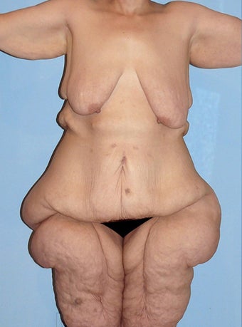 50 Year Old Female Extreme Makeover Body Lift before 660118