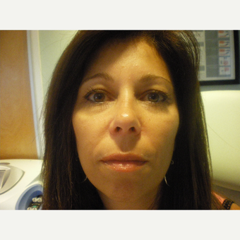 45-54 year old woman treated with Restylane Lyft after 3076783