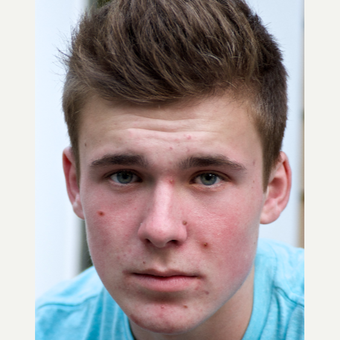 17 or under year old man treated with Accutane before 3004620