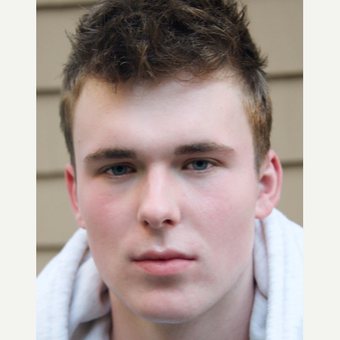 17 or under year old man treated with Accutane after 3004620