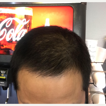 25-34 year old man treated with Hair Transplant after 3618770