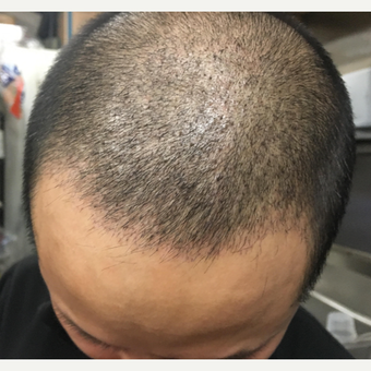 25-34 year old man treated with Hair Transplant before 3618770