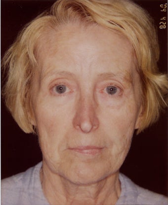Liquid Face Lift using Botox, Pixel laser, Restylane, Botox and Platelet Rich Plasma before 359386