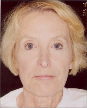 Liquid Face Lift using Botox, Pixel laser, Restylane, Botox and Platelet Rich Plasma after 359386