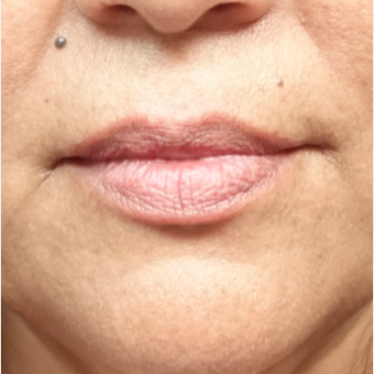 45-54 year old woman treated with Restylane before 3280236