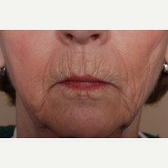 Hetters Peel around the mouth and Fat Injections before 2112883