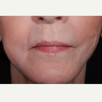 Hetters Peel around the mouth and Fat Injections after 2112883