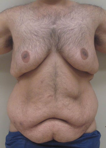 28 year old male who underwent body lift before 1422641