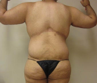 28 year old male who underwent body lift 1422641