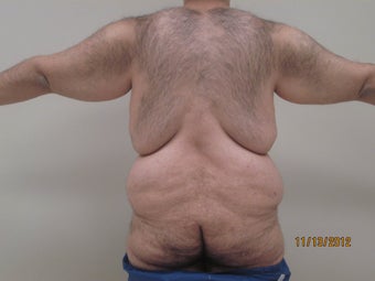 28 year old male who underwent body lift 1422641