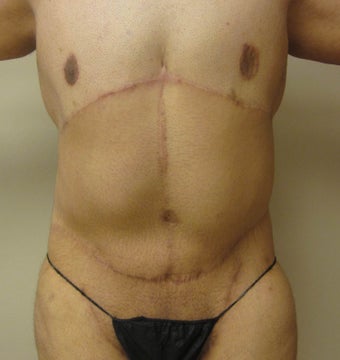 28 year old male who underwent body lift after 1422641