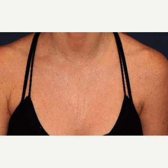 49 year old woman treated with Fraxel Dual Laser one time after 2839357