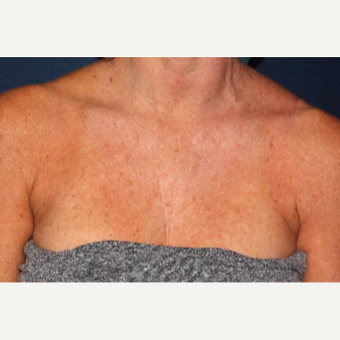 49 year old woman treated with Fraxel Dual Laser one time before 2839357