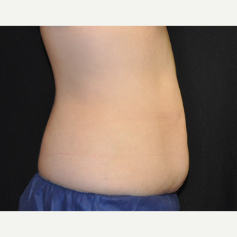 25-34 year old woman treated with CoolSculpting on Abdomen after 3219609