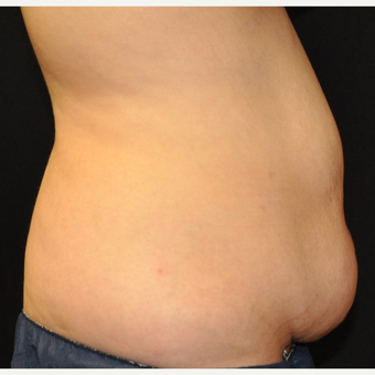 25-34 year old woman treated with CoolSculpting on Abdomen before 3219609