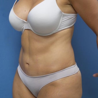 35-44 year old woman treated with Tummy Tuck Revision after 2144428
