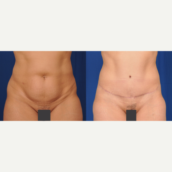 35-44 year old woman treated with Tummy Tuck before 3590264