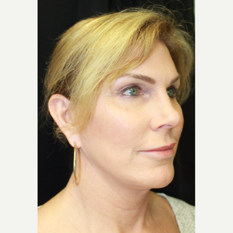 45-54 year old woman treated with Facial Feminization Surgery before 3741506