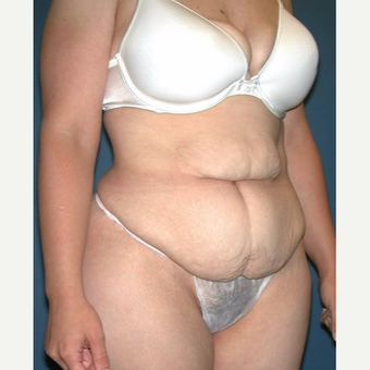 35-44 year old woman treated with No-Drain Tummy Tuck before 3649341