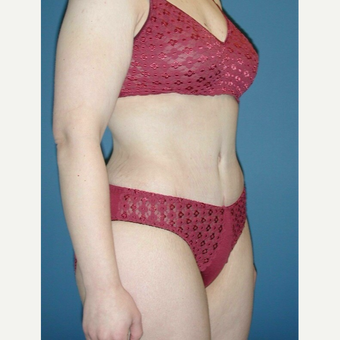35-44 year old woman treated with No-Drain Tummy Tuck after 3649341