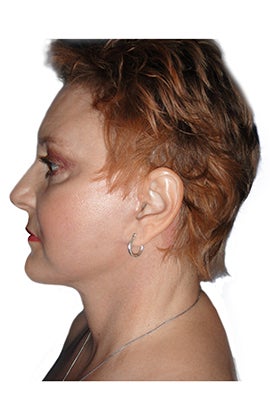 Facelift, necklift, lower blepharoplasty, browlift after 345196