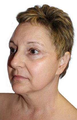 Facelift, necklift, lower blepharoplasty, browlift 345196