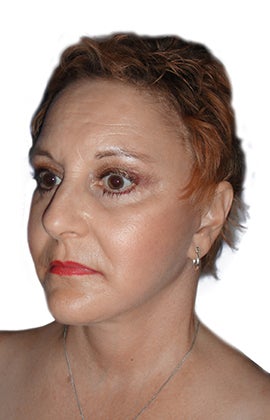 Facelift, necklift, lower blepharoplasty, browlift 345196