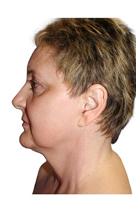 Facelift, necklift, lower blepharoplasty, browlift before 345196