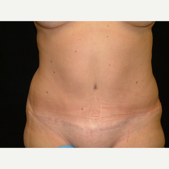 35-44 year old woman treated with Full Tummy Tuck after 3141919