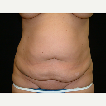 35-44 year old woman treated with Full Tummy Tuck before 3141919