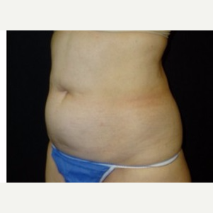 55-64 year old woman treated with CoolSculpting before 3181842
