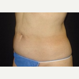 55-64 year old woman treated with CoolSculpting after 3181842