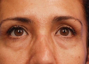 Lower blepharoplasty with fat repositioning before 3170793