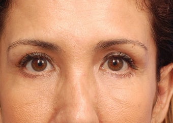 Lower blepharoplasty with fat repositioning after 3170793