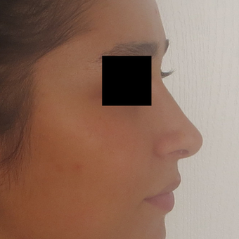 18-24 year old woman treated with Rhinoplasty after 3511014