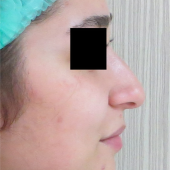 18-24 year old woman treated with Rhinoplasty before 3511014