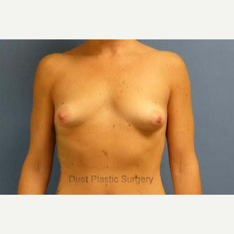 25 year old woman with tuberous breasts treated with implant reconstruction before 3095680