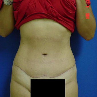 35-44 year old woman treated with Tummy Tuck after 3287667