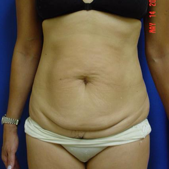 35-44 year old woman treated with Tummy Tuck before 3287667