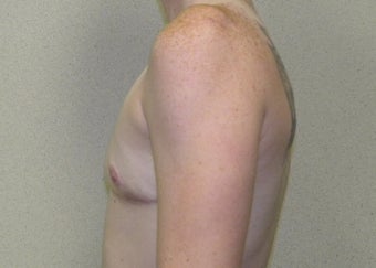 Transgender Female to Male top surgery 1191125