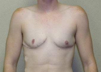 Transgender Female to Male top surgery after 1191125