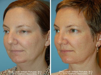 Neck Liposuction before 1389501