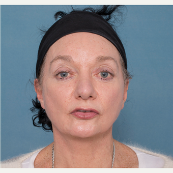 55-64 year old woman treated with Face and Neck Lift after 3532717