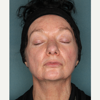 55-64 year old woman treated with Face and Neck Lift before 3532717