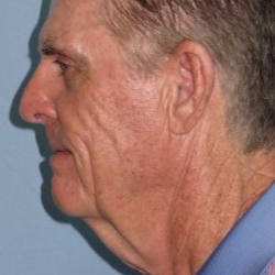65-74 year old man treated with Neck Lift before 3722216