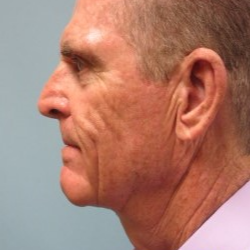 65-74 year old man treated with Neck Lift after 3722216