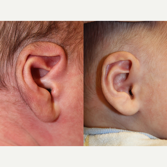 1 month old child treated with EarWell Appliance. after 3542197