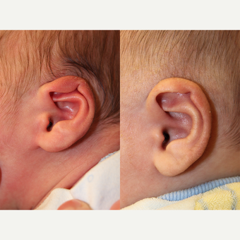 1 month old child treated with EarWell Appliance. before 3542197